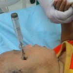 Em bé 14 tháng tuổi bị vít thử điện đâm vào đầu khi ngã